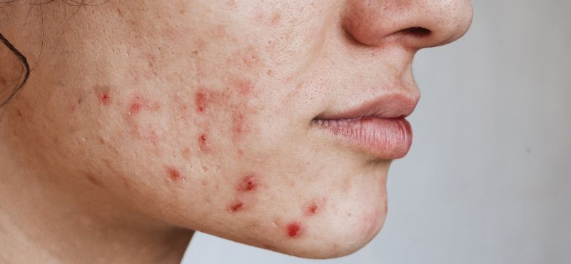 cicatrizes de acne no rosto