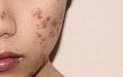 Há tratamento para cicatriz de acne?