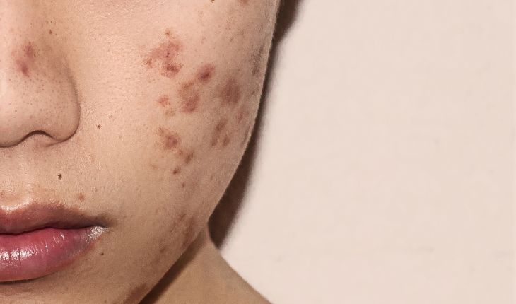 cicatrizes de acne no rosto de uma mulher