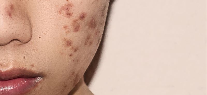 mulher com cicatriz de acne