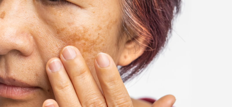 Mulher vendo o melasma em seu rosto